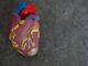 Is It True that Moderna’s Side Effects Cause Heart Attacks? Moderna vaccine effect