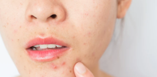 Google Lens Introduces AI-Powered Skin Condition Search, Revolutionizing Dermatological Insights