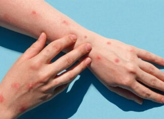 Monkeypox Deemed Lethal, 29 Cases Recorded in Indonesia monkeypox