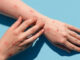 Monkeypox Deemed Lethal, 29 Cases Recorded in Indonesia monkeypox